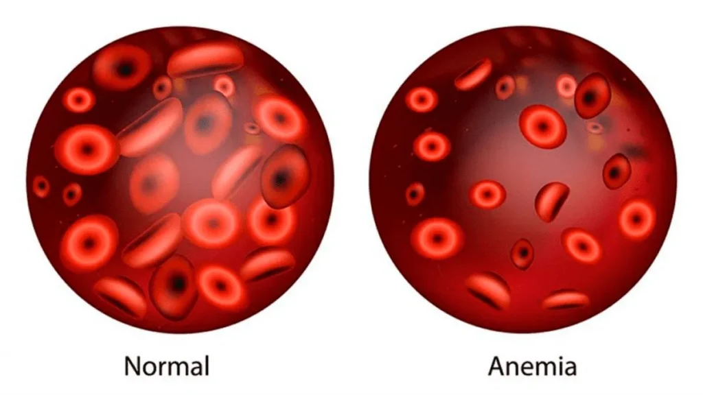 anemia