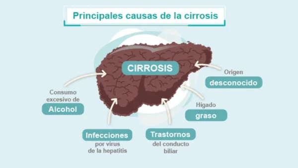 cirrosis