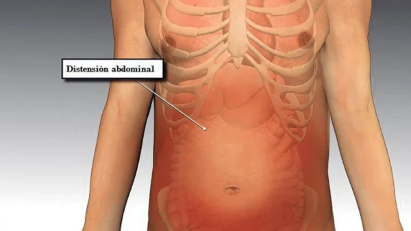 distension-abdominal