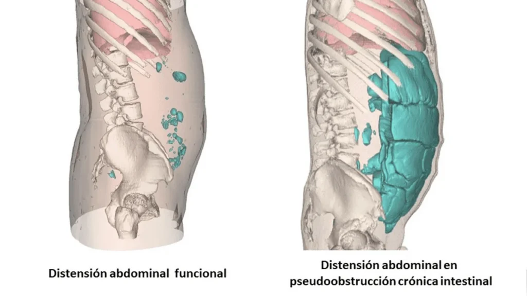 distensión abdominal