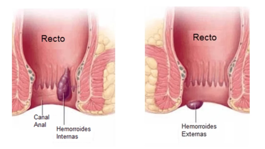 hemorroides