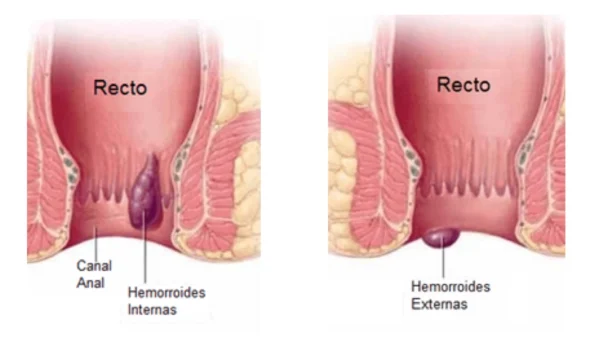 hemorroides