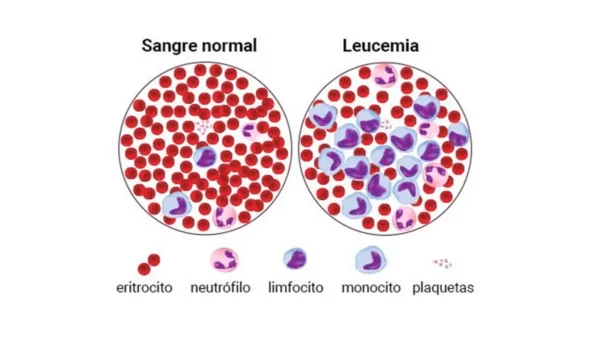 leucemia