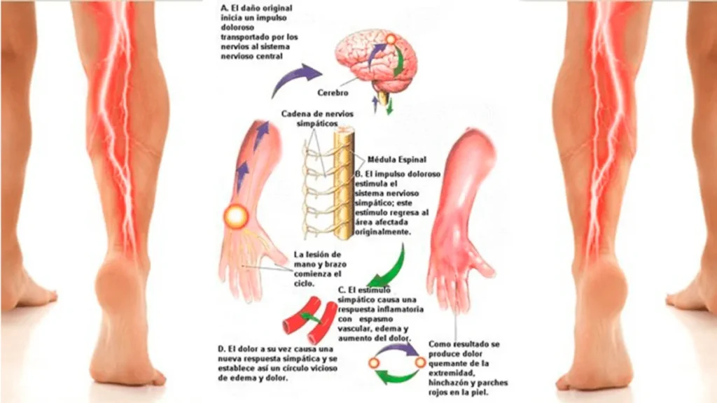 neuropatía-periférica