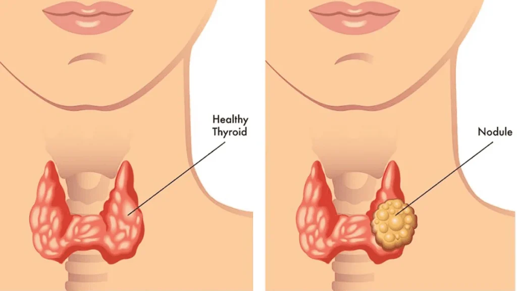 nódulos-tiroideos