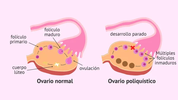 ovario-poliquistico