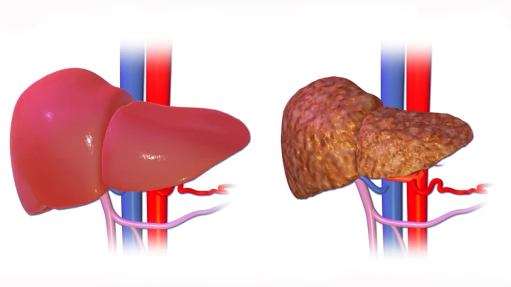 trastornos-hepatobiliares